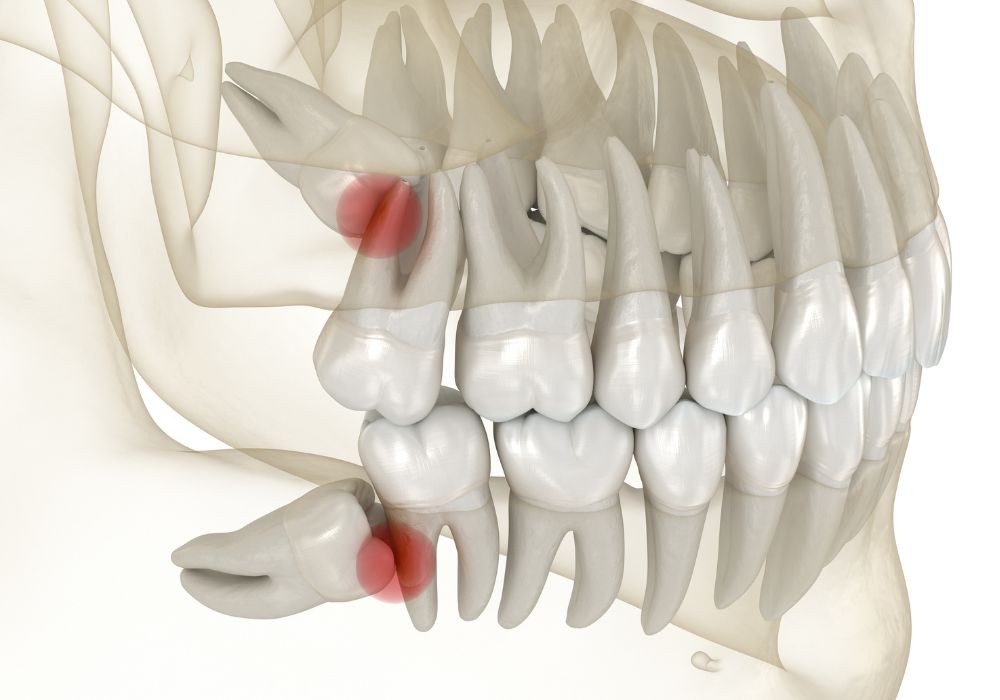 Dr Alexandru BARNA - Dentiste Granville - Extraction dent de sagesse