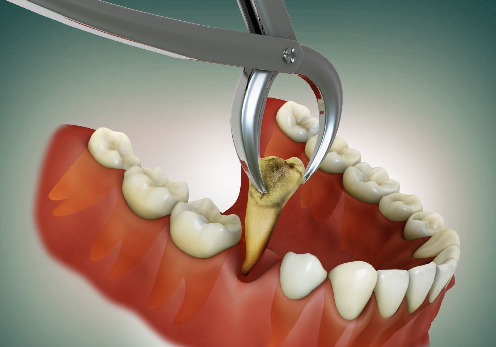 Dr Alexandru BARNA - Dentiste Granville - Extraction dentaire