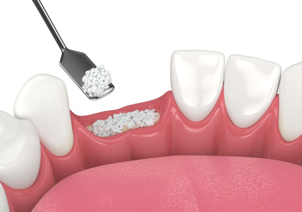 Dr Alexandru BARNA - Dentiste Granville - Greffe osseuse