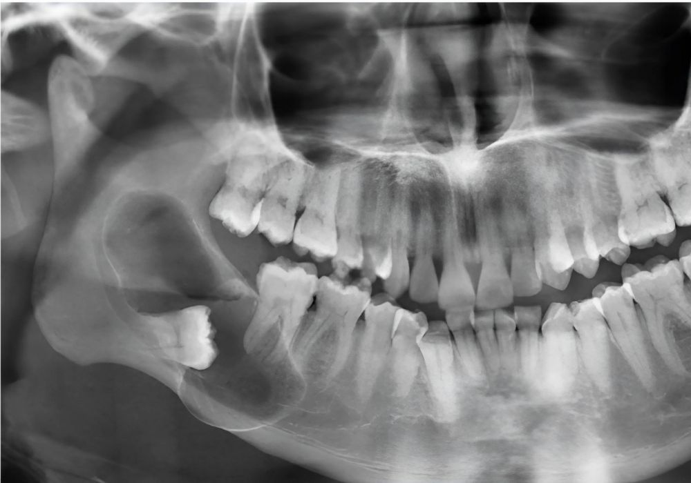 Dr Alexandru BARNA - Dentiste Granville - Kyste