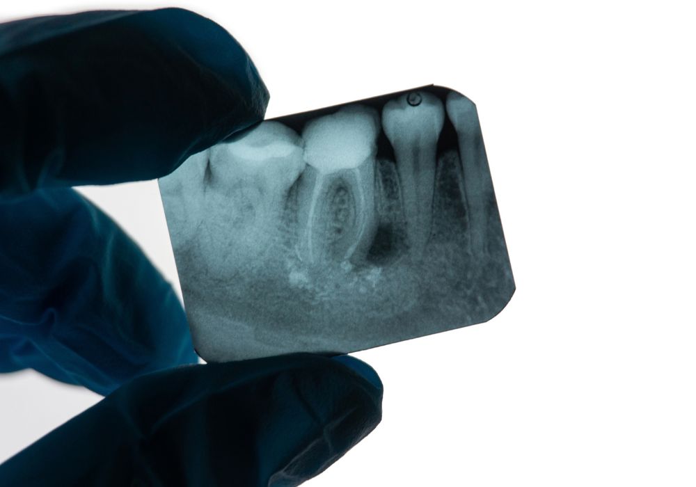 Dr Alexandru BARNA - Dentiste Granville - lesion apicale