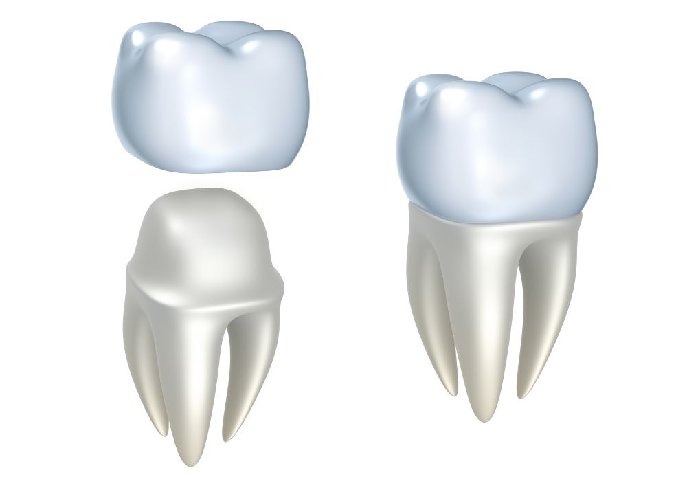 Dr Alexandru BARNA - Dentiste Granville - Couronne dentaire