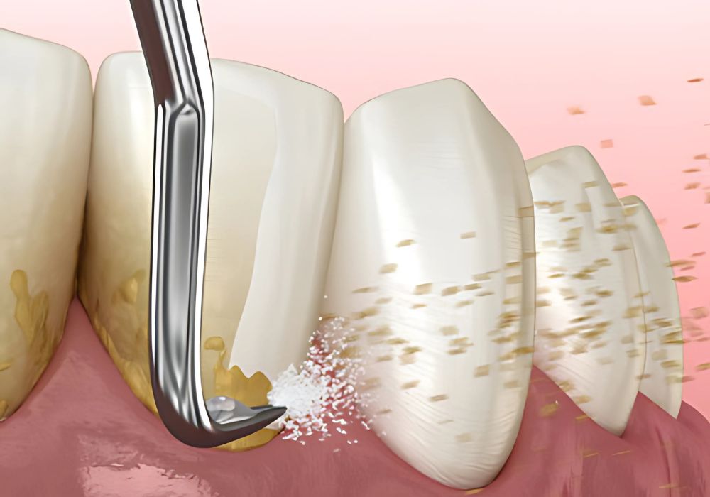 Dr Alexandru BARNA - Dentiste Granville - Détartrage dentaire