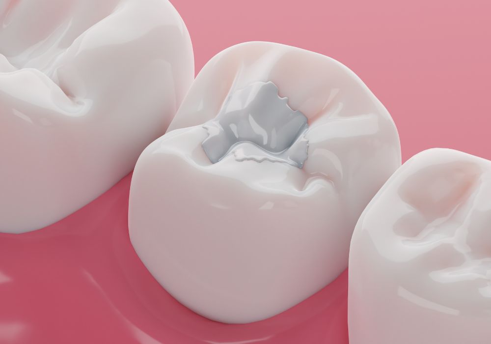 Dr Alexandru BARNA - Dentiste Granville - Composite dentaire