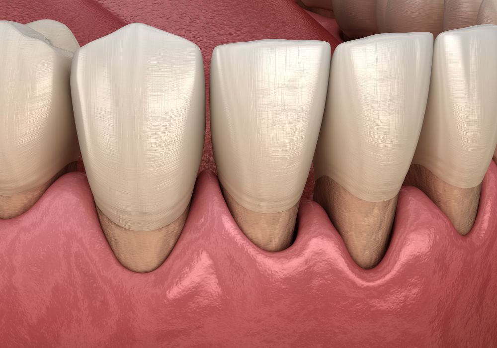 Dr Alexandru BARNA - Dentiste Granville - maladie parodontale