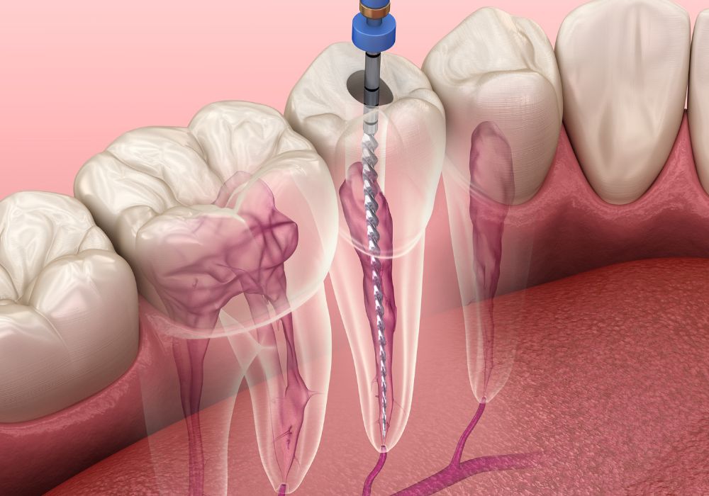 Dr Alexandru BARNA - Dentiste Granville - Endodontie