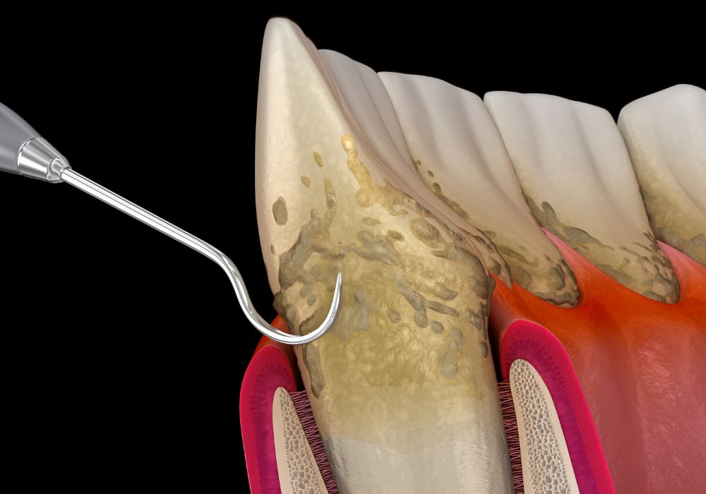 Dr Alexandru BARNA - Dentiste Granville - Surfaçage radiculaire